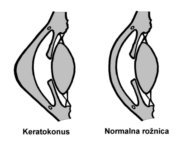 Diagram showing a keratoconus cornea bulging into a cone shape compared with a normal cornea.